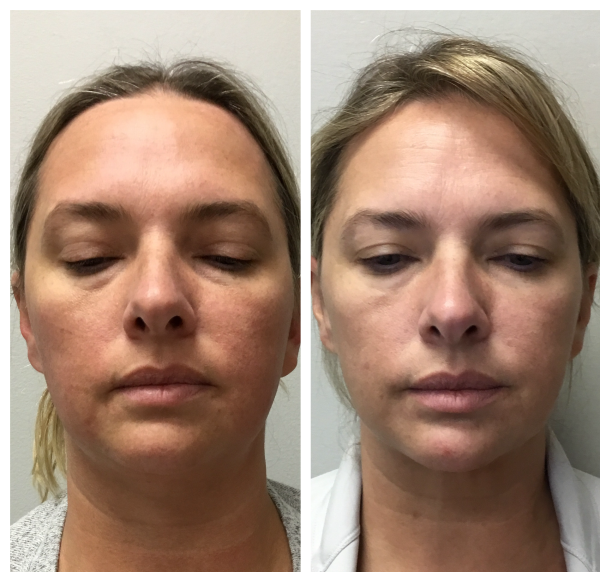 EMFACE Treatment in New Orleans before and after